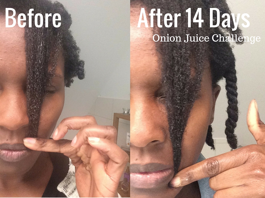 Onion Juice For Hair Growth - Frolicious Deine Afro Haare Pflegen.